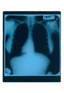 Marilyn Monroe Chest/Pelvic X-Ray